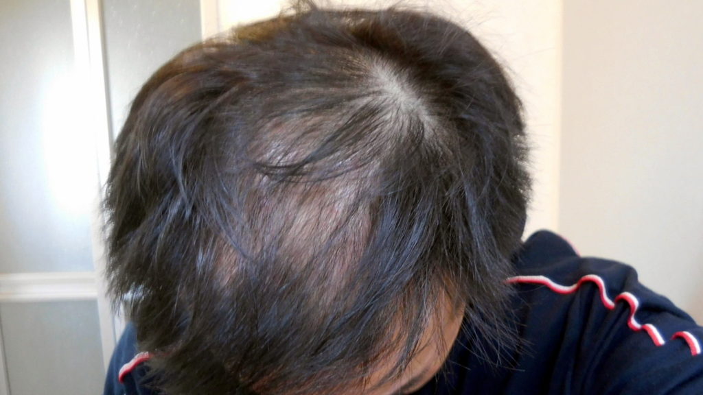 薄毛の男性は 椿油 ヘアオイル で髪の毛をボリュームアップできる ハゲ隠しに最適 Bigoran ビゴラン